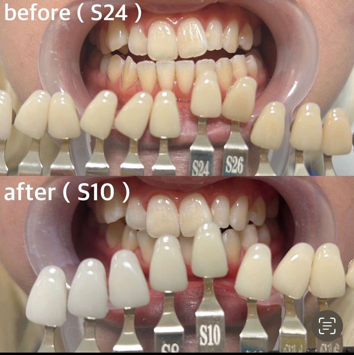 ホワイトニング1回でどのくらい明るくなるの?にお答え💡